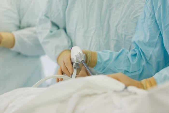 what is male sterilisation