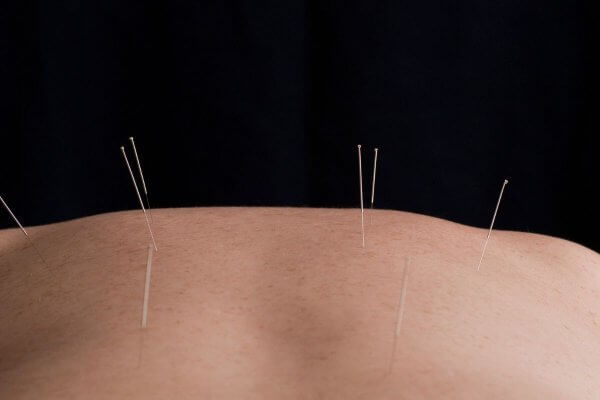 Set of acupuncture needles inserted in the back - lifestyle changes option for some medical conditions