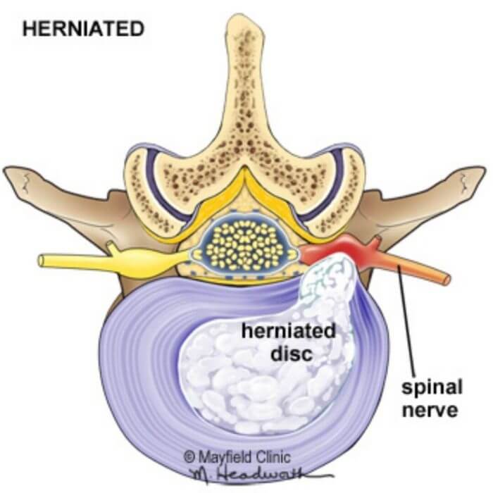 Image of a vertebral bone with part of the spinal cord showing herniated disc