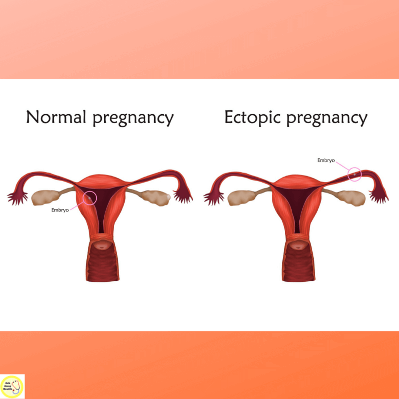 Ectopic Pregnancy