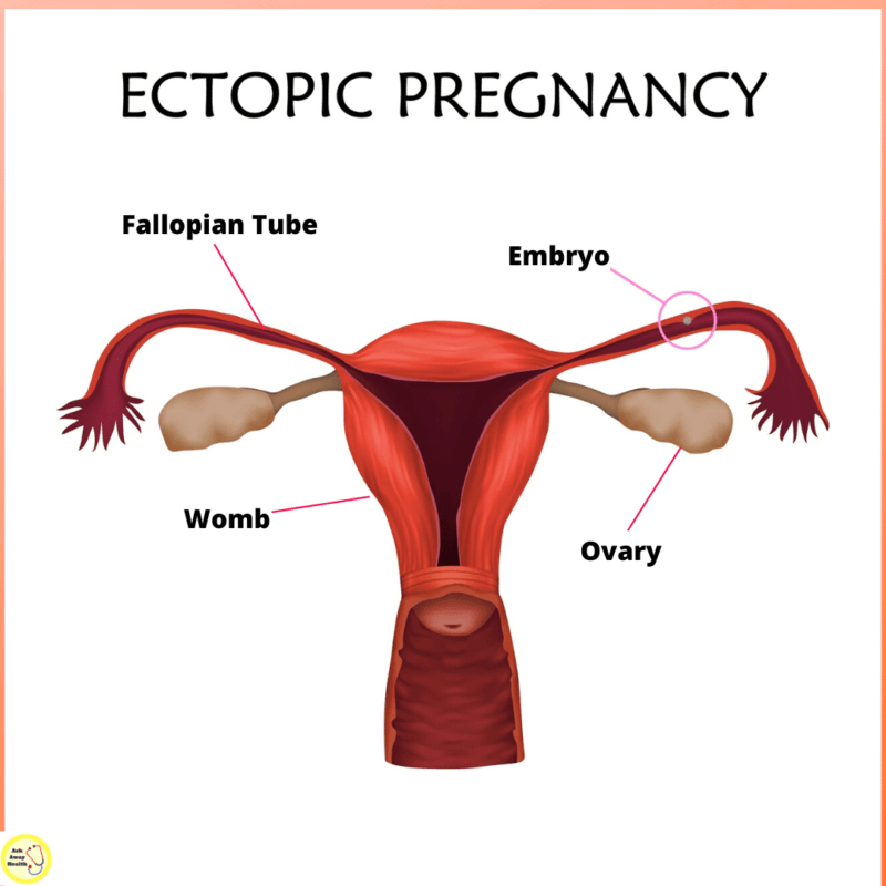 Ectopic Pregnancy Symptoms