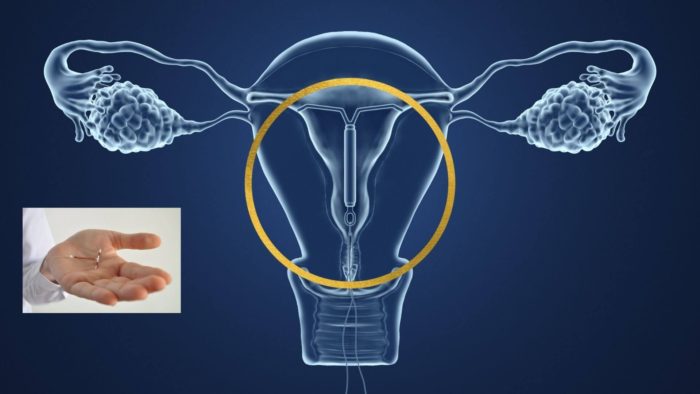 A Copper Coil placed in the womb is an effective form of emergency contraception