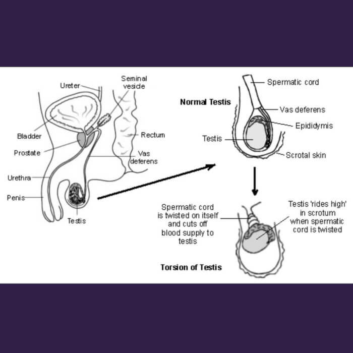 Drawing of the man's testis - normal and abnormal conditions