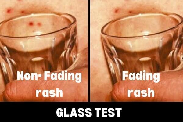 Glass test - the difference between the fading and non-fading rash