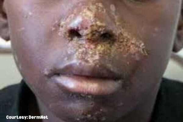 Group A Streptococcus impetigo lesions on the face of a young boy