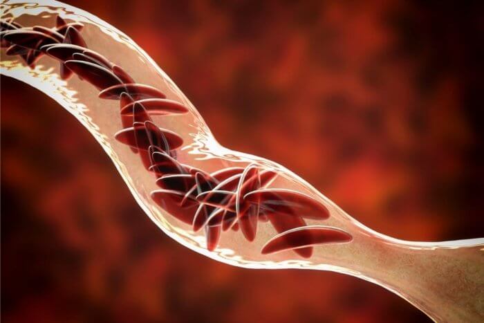 Haemoglobin SC Disease - abnormal blood cells can block a blood vessel or organ to cause health complications