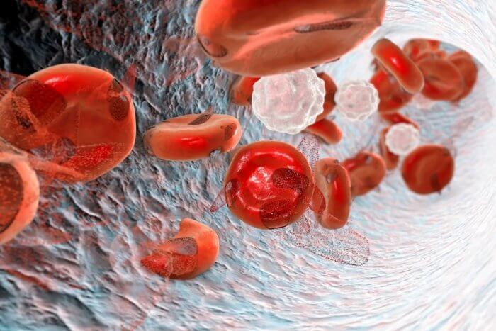 Sickle cell crises