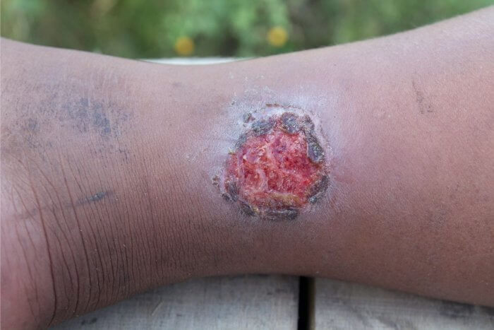 sickle cell