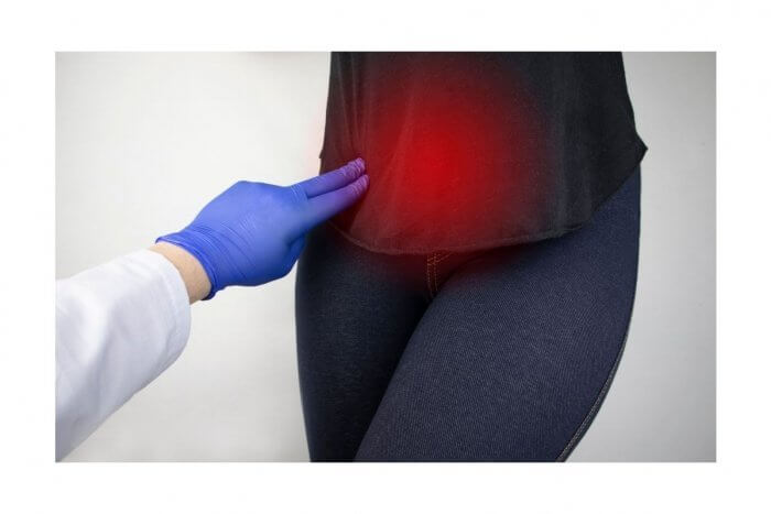 Doctor's gloved hand pointing at a woman's pelvis indicating where Painful Fibroids may be located