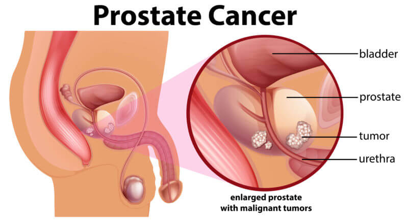 What Prostate Cancer is about