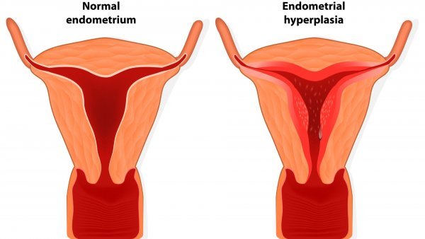 Signs of Endometriosis. Graphic showing how normal endometrium v endometrial hyperplasia (thickening)