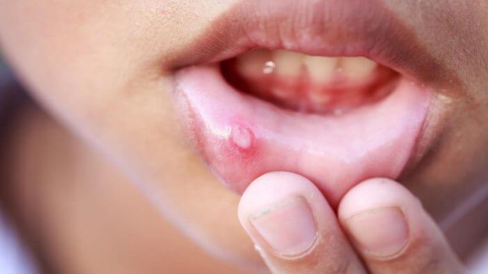 Ulcer on the inside of the lower lip