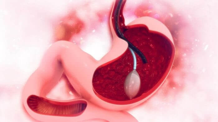 Image of the side view inside the stomach showing how endoscopy is performed to identify stomach ulcers