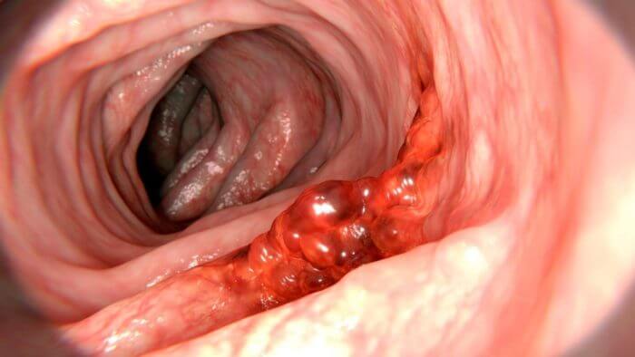 Lining of the gastrintestinal tract from endoscopy showing an ulcer.