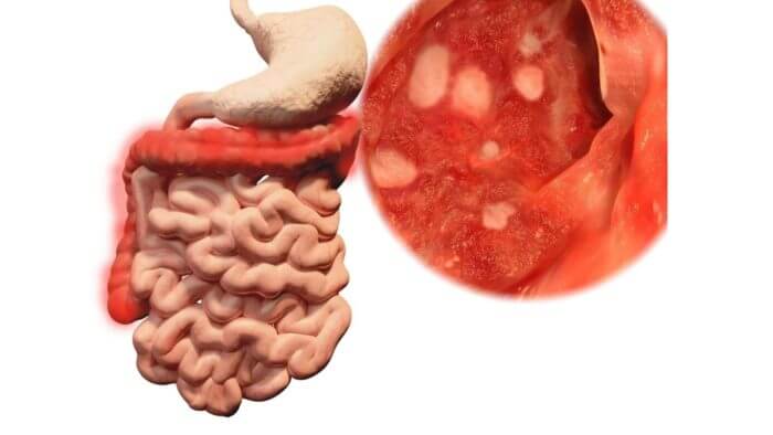 Gastrintestinal system showing stomach and intestine with an outsert of the inner linig of the stomach revealing several ulcers