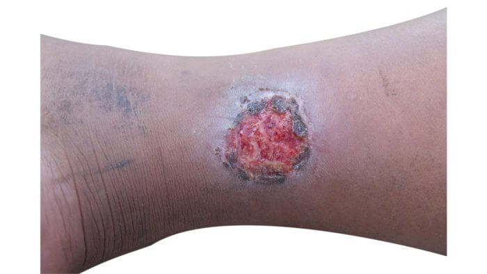 Image of a circular ulcer on the skin of the lowerleg in an african person