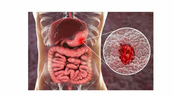 Stomach and Intestines - little insert shows an ulcer.