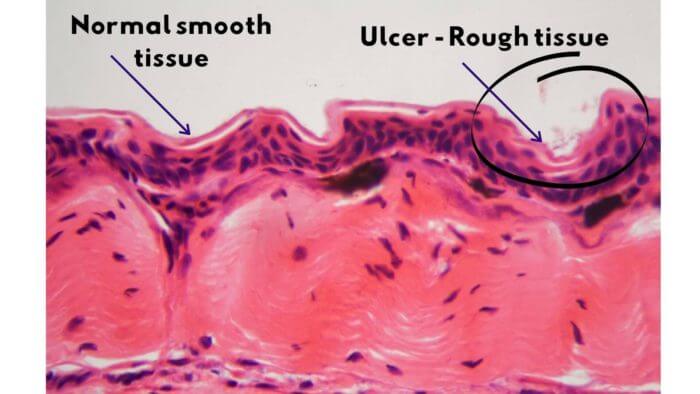 Photo of internal tissue structure showing smooth normal lining versus rough ulcer lining