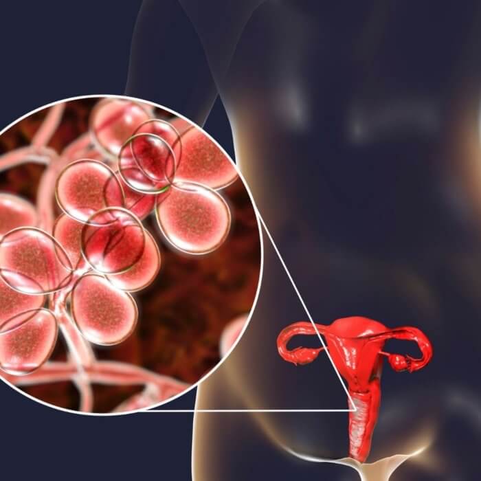 Yeast Infections in women affect the vulva and vagina