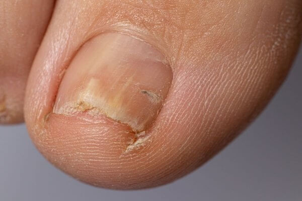 childhood fungal infections
