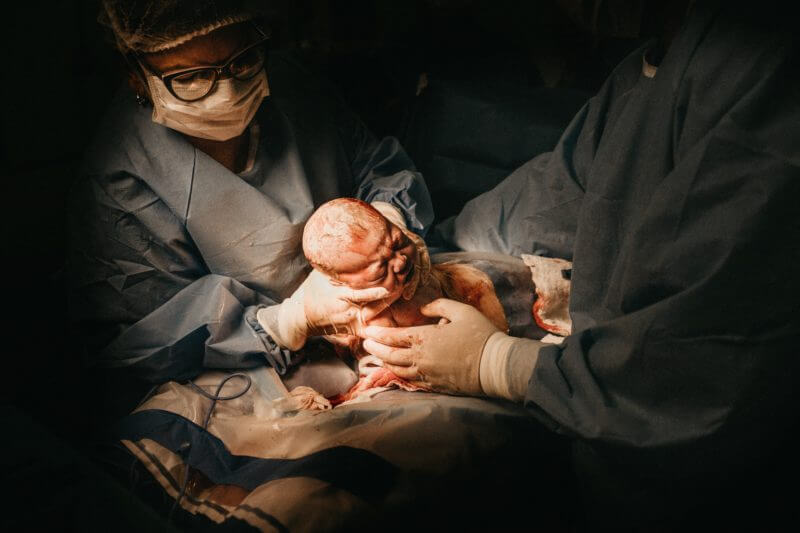 Reasons for C-section birth; dotors pulling a baby out following surgery