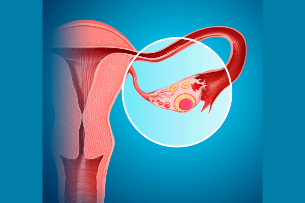 Image of the ovary, fallopian tube and womb - the ovary which is releasing an egg is circled - this happens during your fertile window